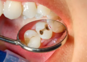 Alasan Mengapa Harus Cabut Gigi Geraham